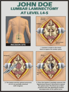 Diagram illustrating lumbar laminectomy at L4-5. Includes incision site on patient's back, and steps showing lamina and ligamentum flavum removal using rongeurs. The spinal nerve and thecal sac are highlighted. Text details surgical procedure, valuable for a spinal cord injury lawyer's insights.